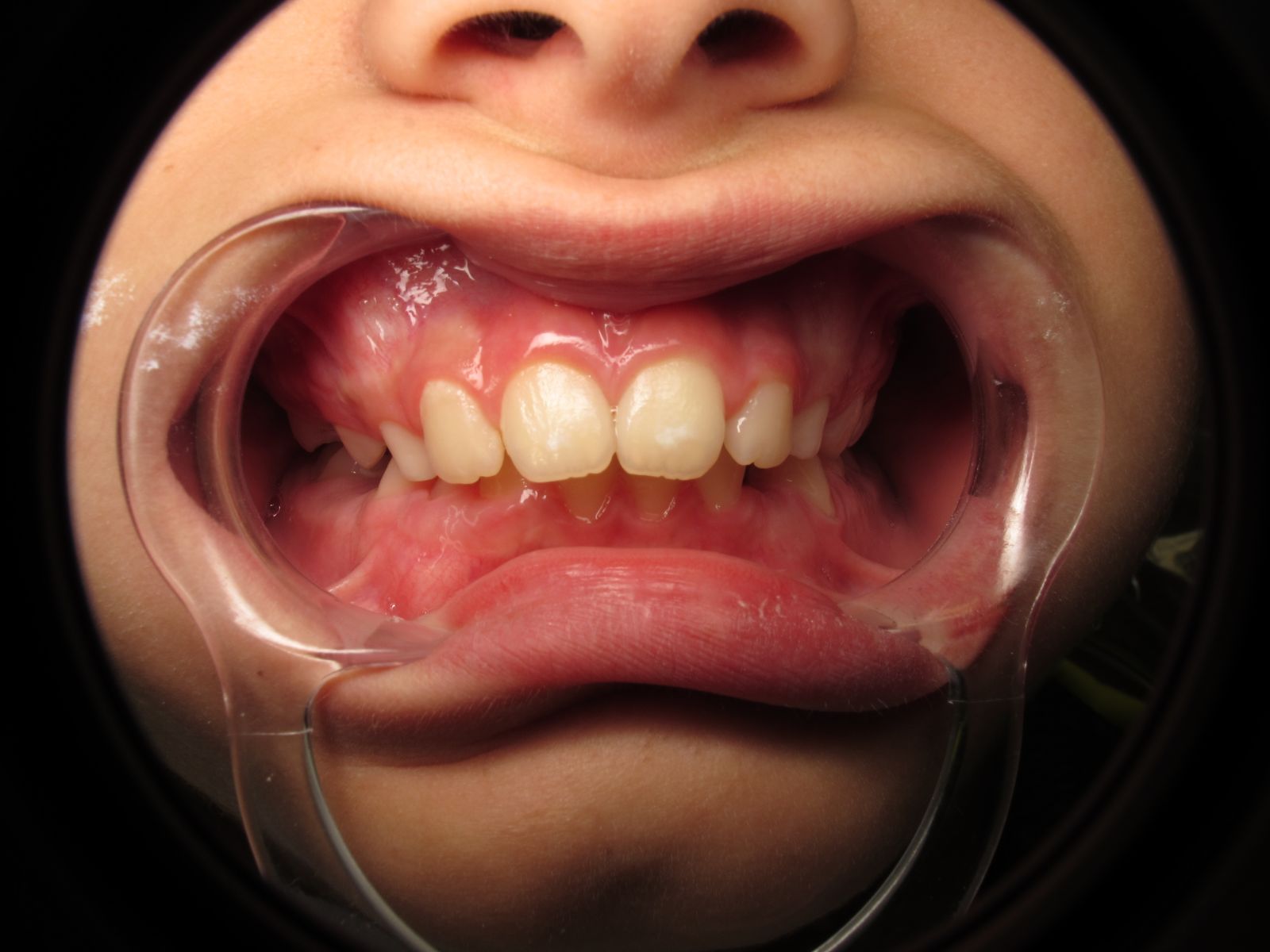 Before & After Harrisonville, MO Custom Dental of Harrisonville